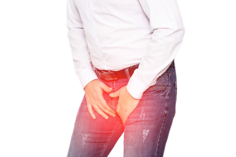 Vulvar Varicosities